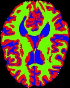 manualmente segmentadas em estruturas anatômicas do cérebro. 5.1.