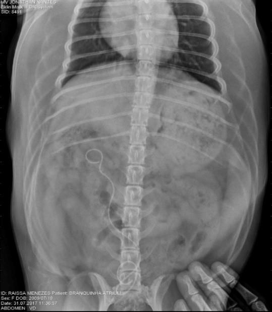 Exames radiográficos realizados em uma cadela da raça Bichon frisé, de 11 anos de idade e 14,6 kg. Observa-se o seguimento radiopaco caracterizado pelo implante de cateter ureterocópico.