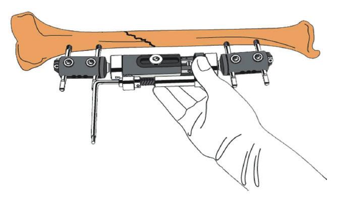 TECNICA CIRURGICA 6. Com a porca de bloqueio do corpo central frouxa, a compressão e distração pode ser aplicada usando a Unidade de Compressão e Distração instalada nas câmaras dos corpos do Fixador.