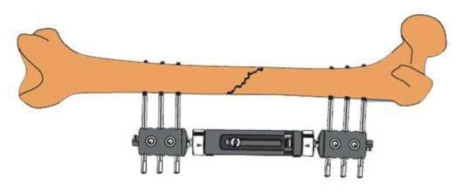 7. TECNICA CIRURGICA 4 - Aplicação do Fixador Clickfix no Úmero Reduza a fratura o mais anatomicamente possível tendo atenção especial na rotação e no comprimento do membro.