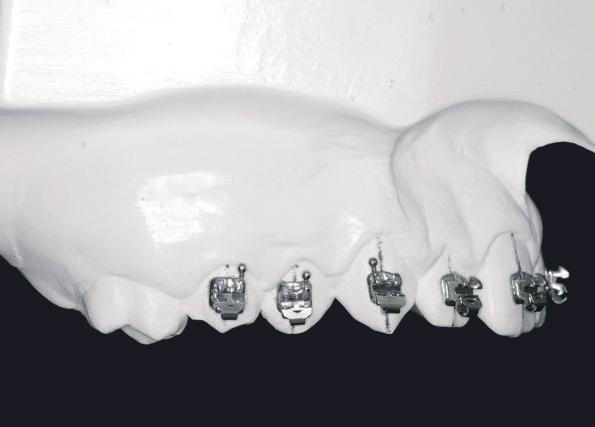 Colagem indireta em Ortodontia descrição de um método simples e eficiente FIGURA 3 - Fotografia