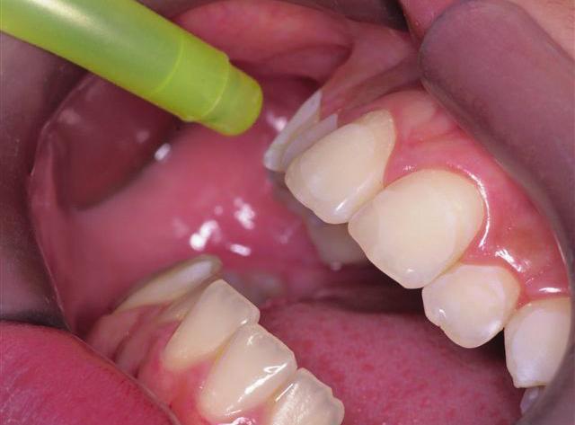 Colagem indireta em Ortodontia descrição de um método simples e eficiente por oclusal e por vestibular. Remove-se, então, os excessos de material extravasado (Fig. 34).