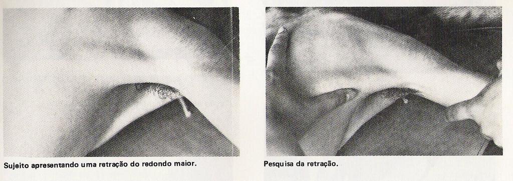 Redondo maior teste realizado junto com grande dorsal, verificar posicionamento do úmero, se rodar medialmente ha possibilidade de encurtamento.