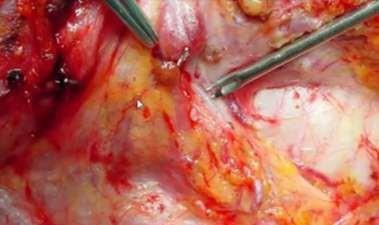 O ponto crucial na tireoidectomia é a identificação do nervo laríngeo recorrente e das glândulas paratireoides.