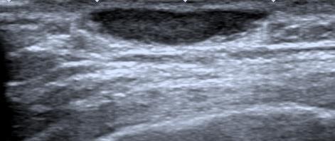 quelóide, verrugas, espinhas, neurofibromas, mamilo acessório.