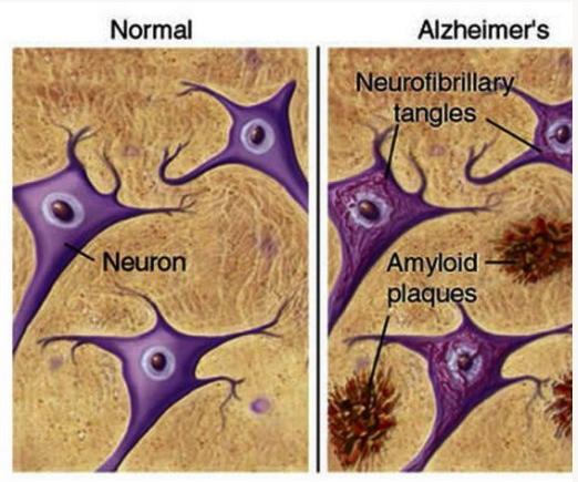 2. Abordagem a Doença Foi Alois Alzheimer, um neurologista alemão que em 1907 descreveu pela primeira vez os sintomas da doença.