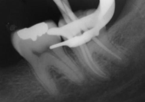 Figura 7: Radiografia de prova dos cones. Figura 8: Sistema Injetor de Gutapercha termoplastificada: Easy-Endo. Figura 9: Radiografia periapical final do tratamento endodôntico do dente 38.