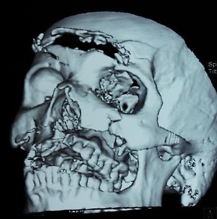 24 Figura 2.1 - (A) Reconstrução de imagem de tomografia exibindo múltiplos traços de fratura em face (B) redução e fixação dos fragmentos pelo uso de miniplacas.