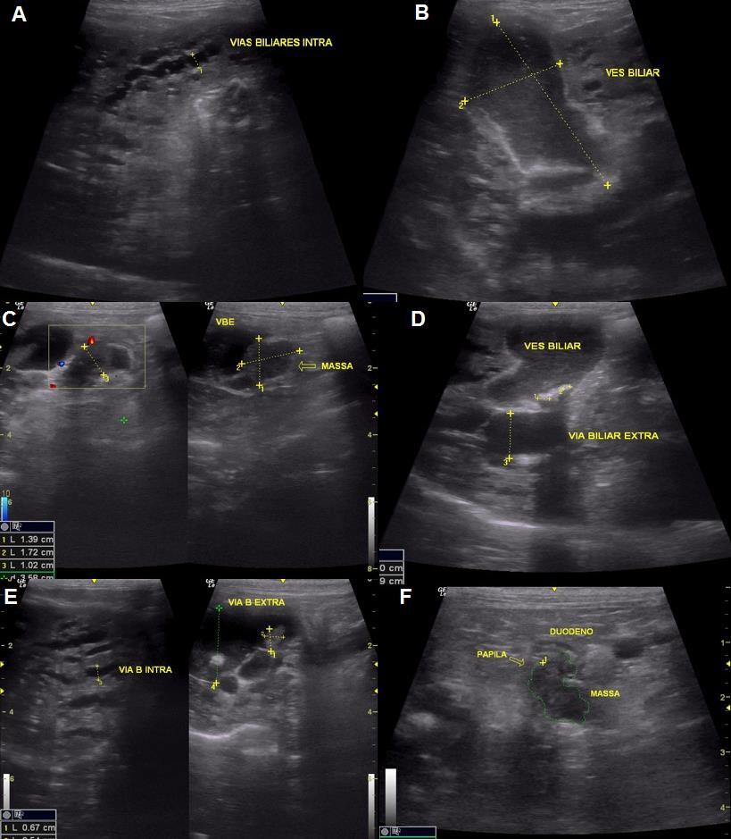 Imagem ilustrativa das alterações ultrassonográficas encontradas 30 dias após o primeiro exame.