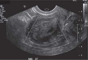 (De Fielding JR et al: Gynecologic imaging, Philadelphia, 2011, Saunders.) Doenças e Distúrbios I A B C D FIG.