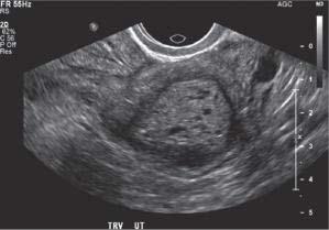 Imagem de ultrassom sagital (US) mostrando tecido mole ecogênico cístico espessado preenchendo a cavidade endometrial