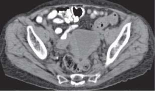 Imagem de US axial mostrando tecido mole ecogênico cístico espessado preenchendo a cavidade endometrial (setas). C.