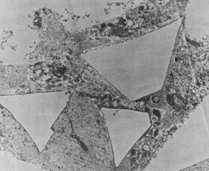Tampão de matriz amorfa e cristalina removido de um gato macho. Os espaços em branco eram ocupados por cristais de estruvita, entremeados por matriz amorfa.