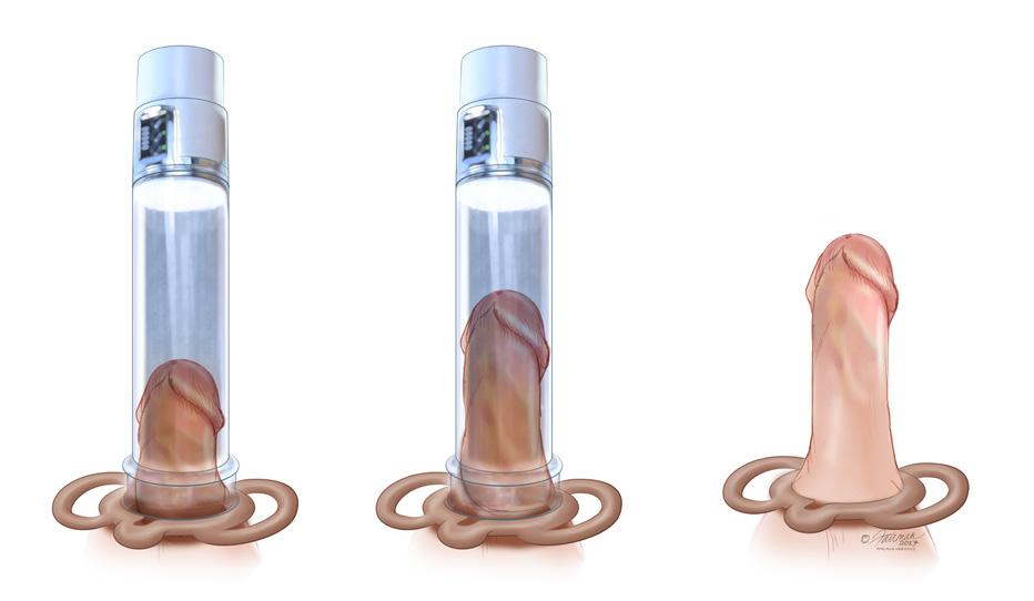 DISPOSITIVO DE EREÇÃO A VÁCUO Um dispositivo de ereção a vácuo é um tubo de plástico que desliza sobre o pênis, criando um isolamento com a pele do corpo.