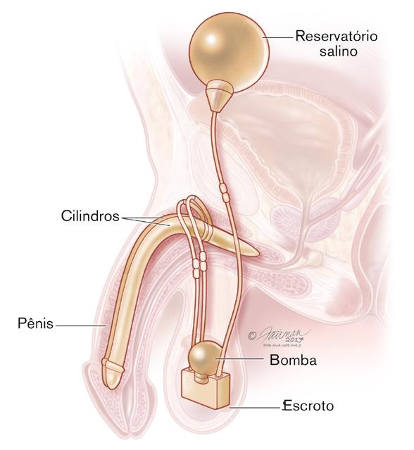 Tratamento cirúrgico O principal tratamento cirúrgico da DE envolve um implante peniano, chamado também de prótese peniana.