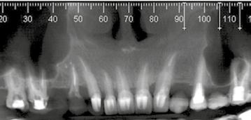 17۰, Corte coronal panorâmico evidenciando a pneumatização do