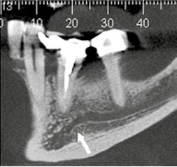 Corte coronal panorâmico ().