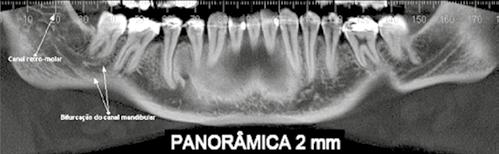 Está localizado abaixo dos ápices dos dentes posteriores inferiores, terminando no forame