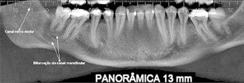 conhecimento da morfologia e topografia do canal mandibular é importante para as intervenções