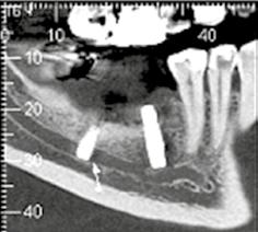 mandibular ().