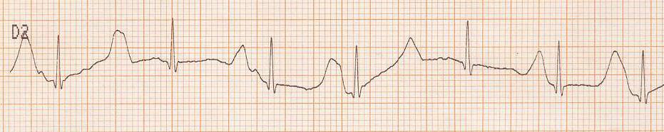 Nos antecedentes familiares havia história de síncopes de repetição (avó materna). O estudo da avó mostrou um QT longo no ECG, refractário á terapêutica, tendo sido implantado um cardiodesfibrilhador.