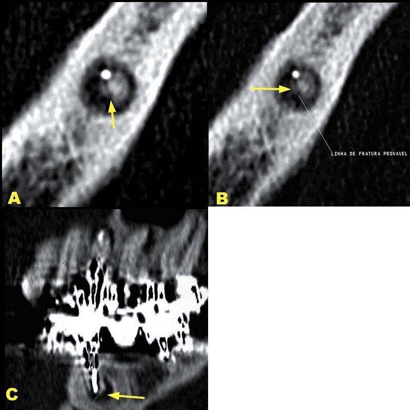 Avaliação comparativa de diferentes meios para o diagnóstico em Endodontia 63 Caso 4 Análise tomográfica: FIGURA 8 FIGURA 8: A.