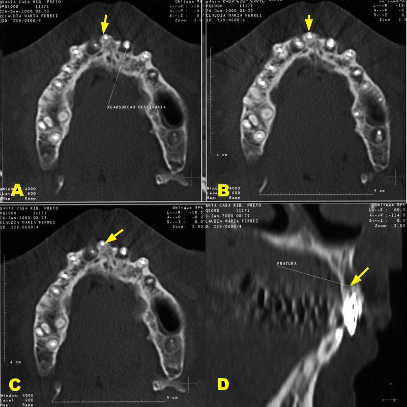 Avaliação comparativa de diferentes meios para o diagnóstico em Endodontia 89 Caso 17 Análise tomográfica: FIGURA 44 FIGURA 44: A.