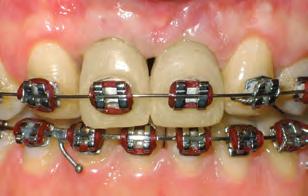 Segundo TJAN & MILLER 34, durante o sorriso, a posição do lábio superior pode delimitar três condições distintas de exposição dos dentes superiores e do tecido gengival, sendo elas a linha de sorriso