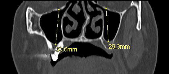 presença de tecido mole) na parede inferior do seio maxilar superior a 2 mm.
