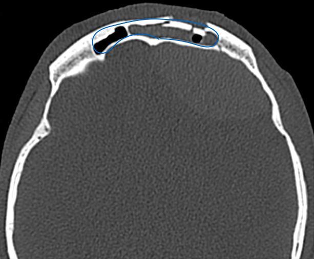 32 Figura 3 - Exemplo tomográfico, corte axial, mostrando um