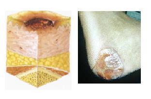 A classificação de UP abrange desde o aparecimento de alterações da pele até o estadiamento das lesões propriamente ditas e se organiza segundo os critérios abaixo descritos: Lesão por Pressão