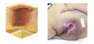 Lesão por Pressão Estágio 3: Perda da pele em sua espessura total na qual a gordura é visível e, frequentemente, tecido de granulação e epíbole (lesão com bordas enroladas) estão presentes.
