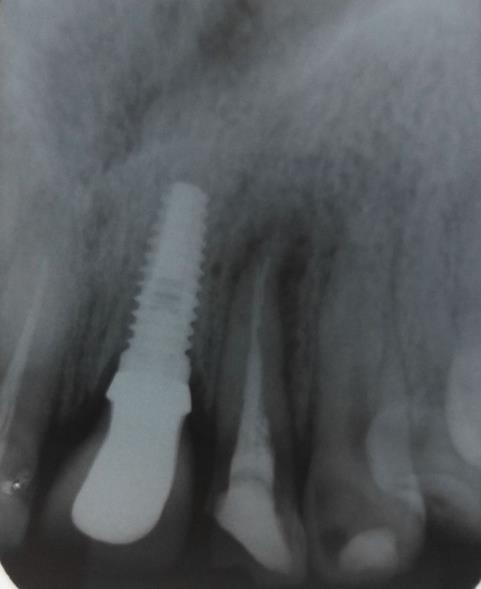 Dentre as etapas constituintes do tratamento endodôntico, a análise da anatomia interna dos dentes a serem tratados, previamente à abertura coronária, deve ser cautelosamente observada para que se