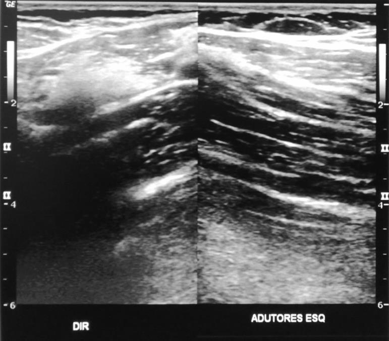 Ultrassonografia (não vê osso) Exames musculoesqueléticos Ideal em estruturas mais superficiais
