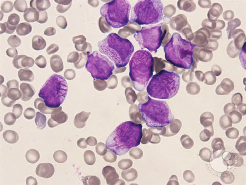 Promyelocytes with Auer rods - 02 Image ID: 5911 Authors: Marco Gambassi Category: Myeloid Neoplasms and acute leukemia (WHO 2016) > Acute Myeloid Leukemia > Acute Myeloid