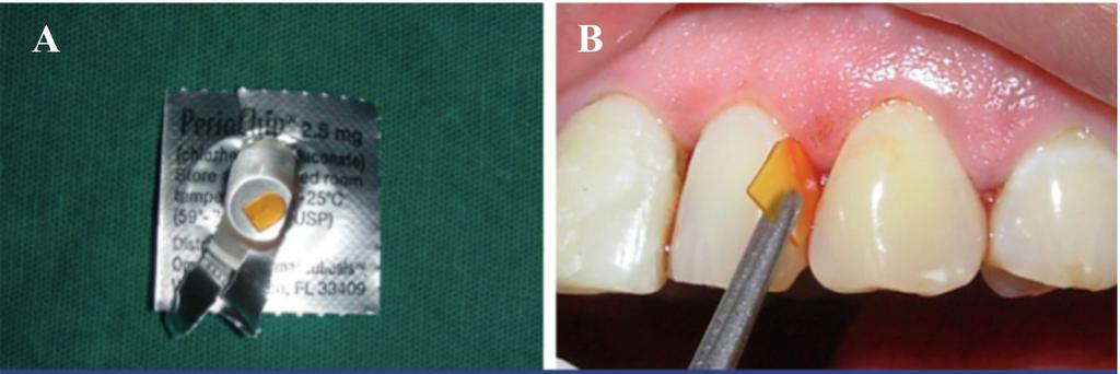 Figura 6: (A) Periochip (contém 2.5mg de gluconato de clorexidina); (B) Colocação do Periochip na bolsa periodontal após SRP (Adaptado de Medaiah et al., 2014).