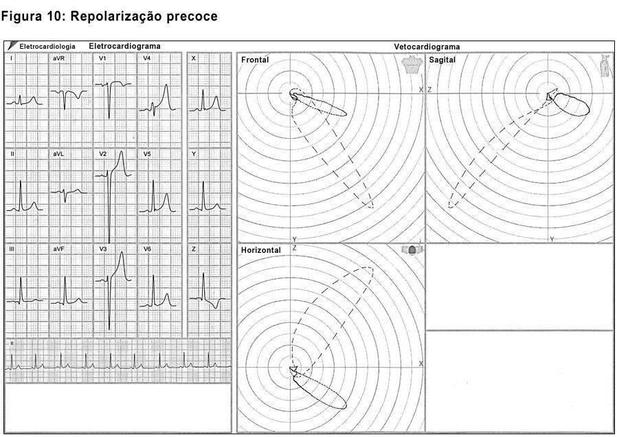 Figura 10 Aspectos eletrovetorcardiográficos característicos da repolarização precoce.