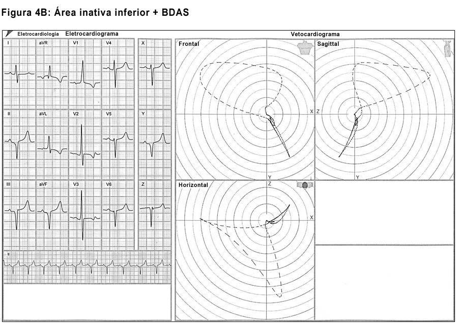 Associação entre BDAS e área eletricamente inativa (AEI) inferior.