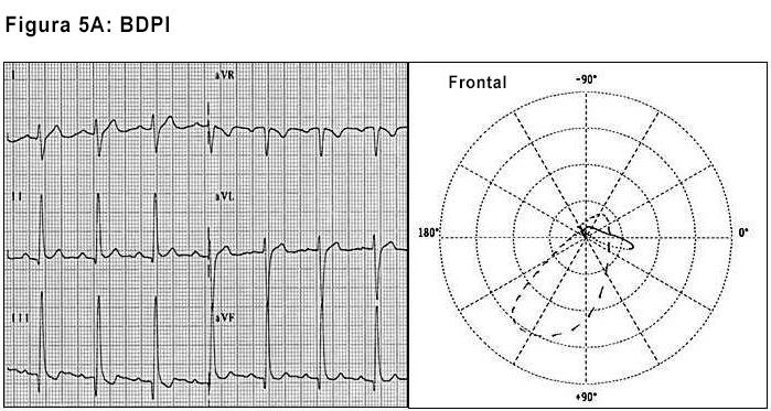 Figura 5 Aspectos eletrovetorcardiográficos do BDAS (Figura 4A). A. Bloqueio divisional posteroinferior (BDPI) esquerdo. B. Bloqueio divisional anteromedial (BDAM) esquerdo.