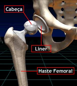 pelo cimento. Nas não cimentadas vai encaixado em uma cúpula metálica que por sua vez é fixa no osso por "Press Fit". Pode ser articulado com cabeças de metal ou de cerâmica. Cerâmica.