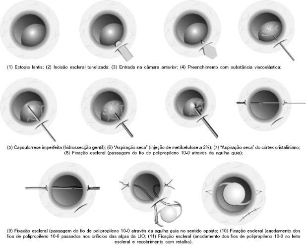 MATERIAIS EM FACECTOMIA A Catarata consiste na opacificação do cristalino. Embora existam diferentes razões para o aparecimento da catarata, a mais comum é o envelhecimento.