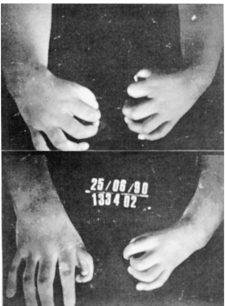 E.P.C. SOUZA, C.B. BARROS, A.M. NOMURA, A.S. REIS Fig. 2 Â é o ângulo de desvio radial, obtido em radiografias AP, em filme único. Os exemplos mostram MTRC sem agenesias dos polegares.