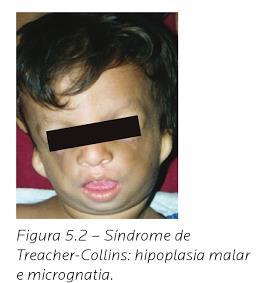ALTERAÇÕES MORFOLÓGICAS DO TERÇO MÉDIO DA FACE HIPOPLASIA MALAR 77 CONDIÇÕES CLÍNICAS GENÉTICAS Espectro oculoauriculovertebral (ou síndrome de Goldenhar)