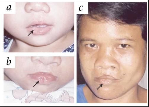 ALTERAÇÕES MORFOLÓGICAS DO TERÇO INFERIOR DA FACE Micrognatia e prognatia Alterações no filtro nasolabial, na boca e nos lábios Filtronasolabial apagado