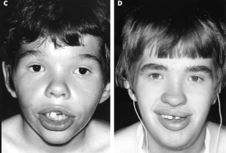 presença de fovéola (pits) característica da síndrome de Van der Woude (que pode ser acompanhada de fissura labial e hipodontia- ausência de dentes prémolares