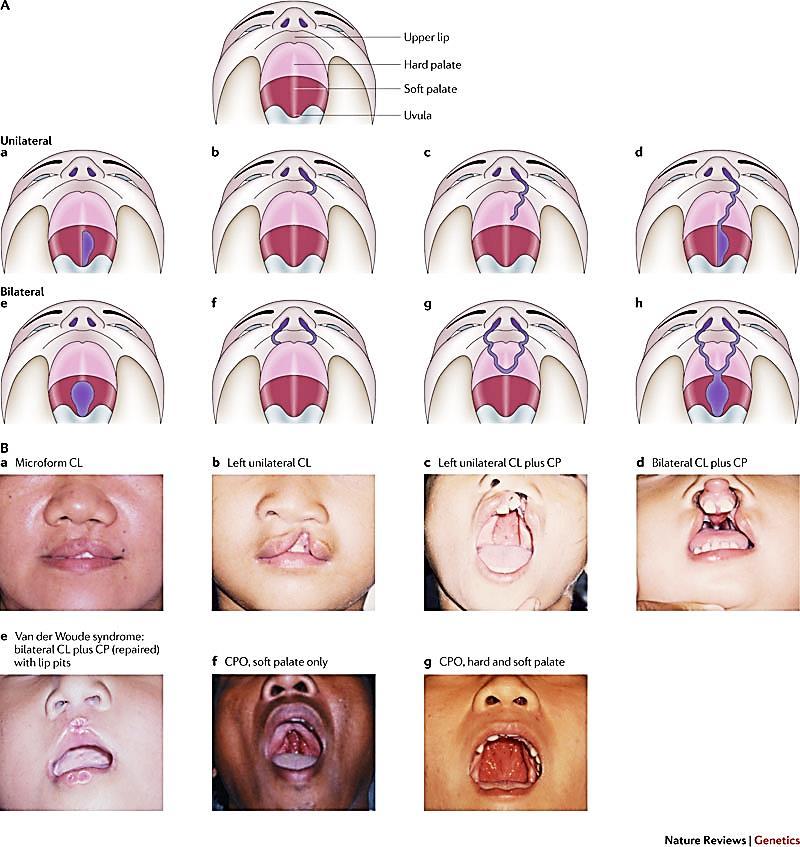 Formas sindrômicas Maioria monogênica Não-sindrômicas defeito isolado Maioria multifatorial AMBIENTAL Efeito do ácido retinóico Cleft lip and palate: understanding genetic and