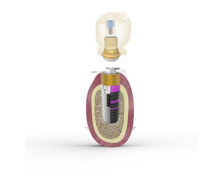 BioBlock A união entre o implante e a prótese é efetuada através de um transepitelial intermédio que se aparafusa ao implante.