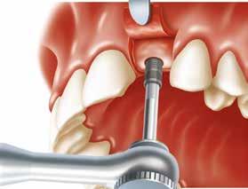 Colocar o implante no local Introduza o instrumento de inserção apropriado diretamente no implante.