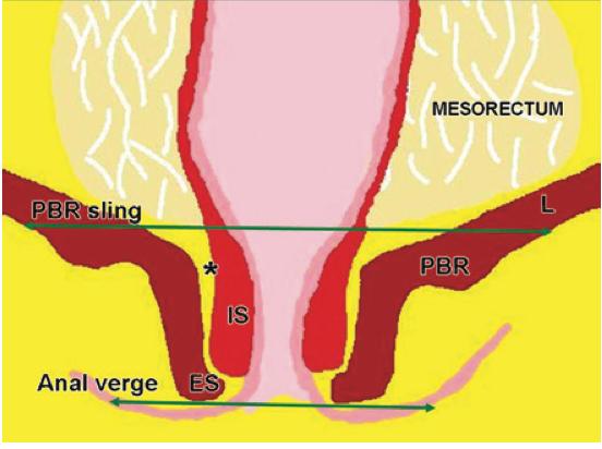 Reto baixo = Menos de 5 cm da borda anal. Médio = 5 10 cm.