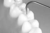 esmalte e sombra na dentina Cavitação Destruição dentina